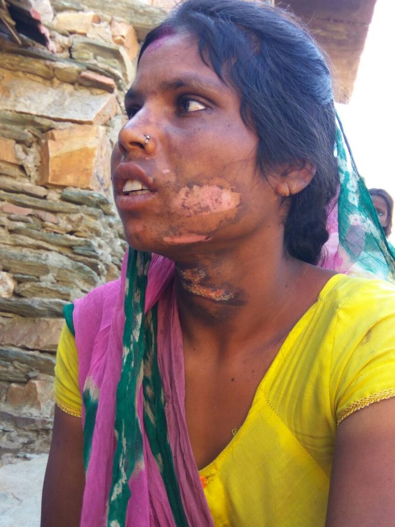 पति और ससुर ने महिला के शरीर को गर्म लोहे के चिमटे से जला दिया – पुलिस ने बताई मामूली घटना